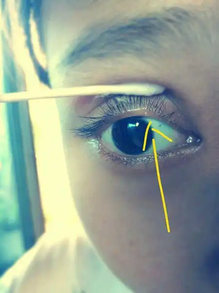 本宝宝眼皮里长了一个奇怪的小疙瘩 不痛不痒的,要不是刚才瞅了一眼
