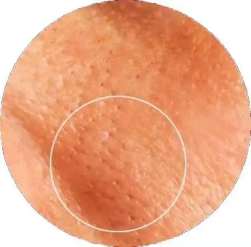 皮肤就会下垂,进而往下拉扯,同时当皮肤内养分不足,毛孔附近的皮肤