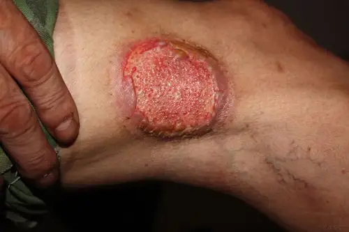 下肢溃疡请教中医高手