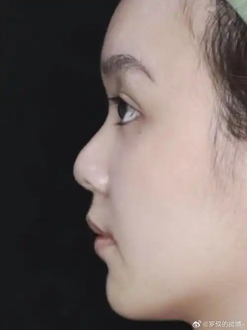 终于可以自信拍侧脸了8715术前问题今天这位宝子的原生鼻整体较塌