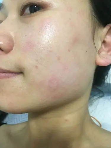 切记脸部过敏千万不要吃它_皮肤