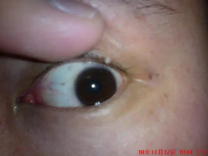 眼皮上长了个肉粒.