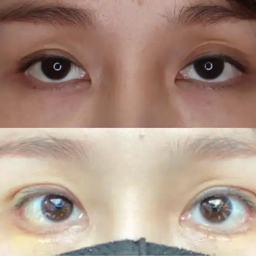 微创双眼皮修复加脂肪颗粒填充眼睛凹陷