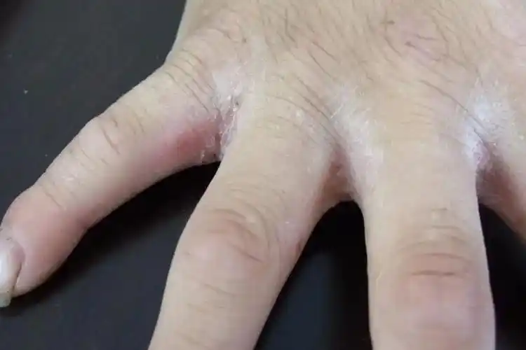 女性的常见的疥疮图片