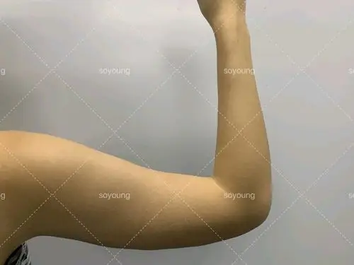 我是有蝴蝶臂,穿衣服看着人很强壮,看了纽蜜做的手臂_圈子-新氧美容