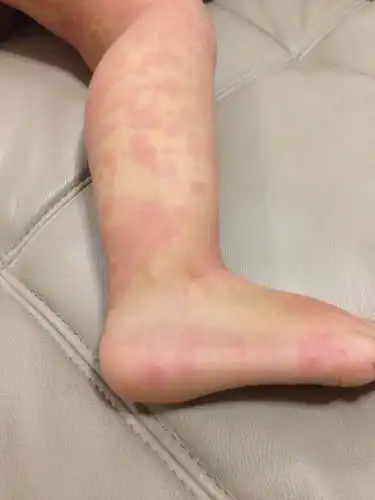 医生说是过敏,打了针说就会好,到现在还这样,发痒就会红,这个是什么