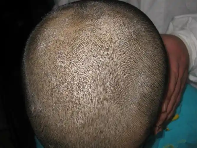 女生的头癣初期图片_有来医生
