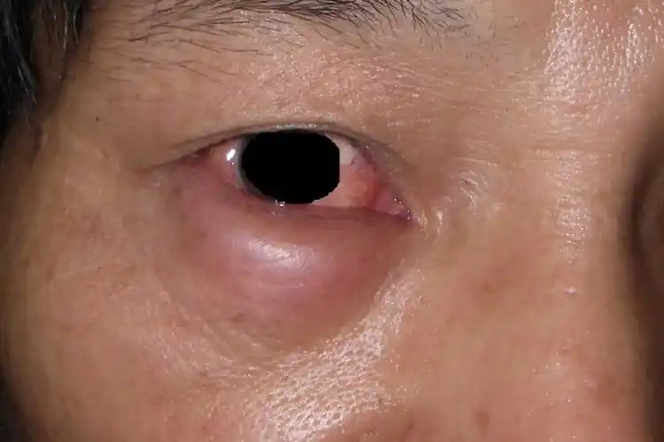 从而出现全身性的水肿,一般先发生于颜面,眼睑,脚踝等部位