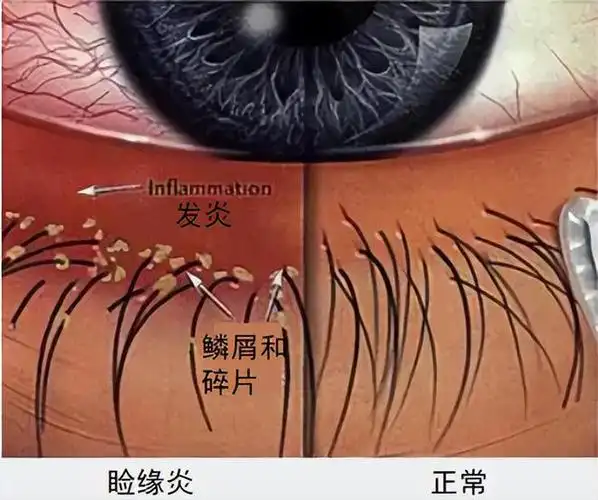 "以泪洗面" 种睫毛的小心了!|睑板|眼睑|结膜|假睫毛_网易订阅