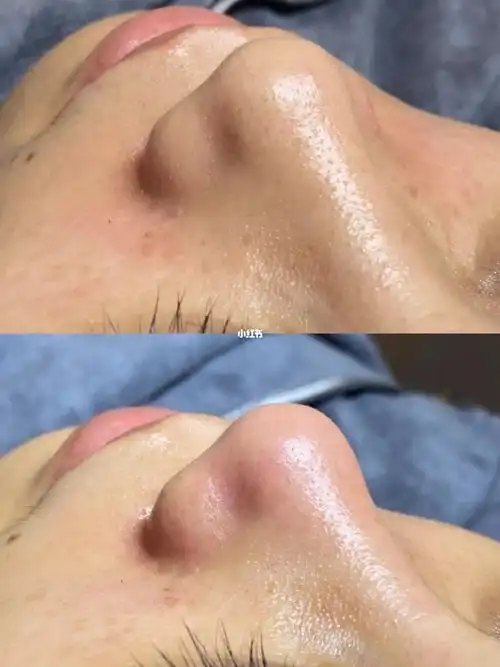 15#毛孔清洁#黑头#黑头粉刺#收缩毛孔#针清闭口  #深层清洁对比