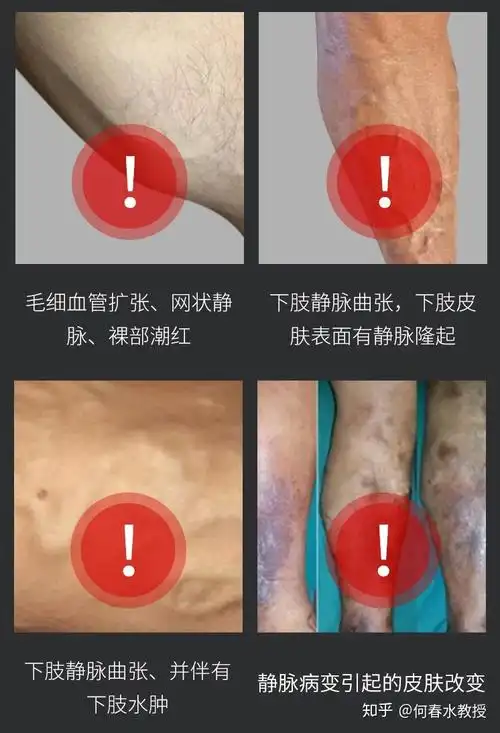 此阶段表现为毛细血管的扩张,为轻度的静脉曲张,这时间在我们的腿上