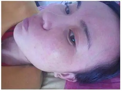 化妆品过敏症状图片48