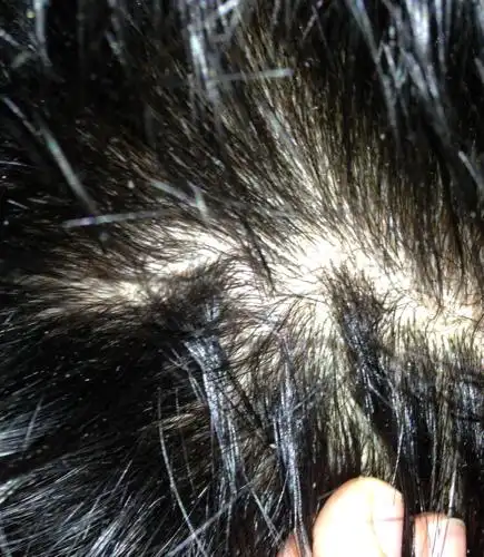 头皮屑多,头发油!头痒怎么办?有办法吗?我勤洗头还是那个样子?