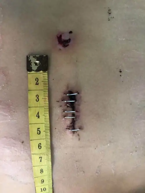 市中心人民医院胸心外科以微创技术"堵心眼",让室间隔缺损患者再也不