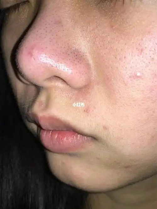 痘痘闭口黑头都没了!