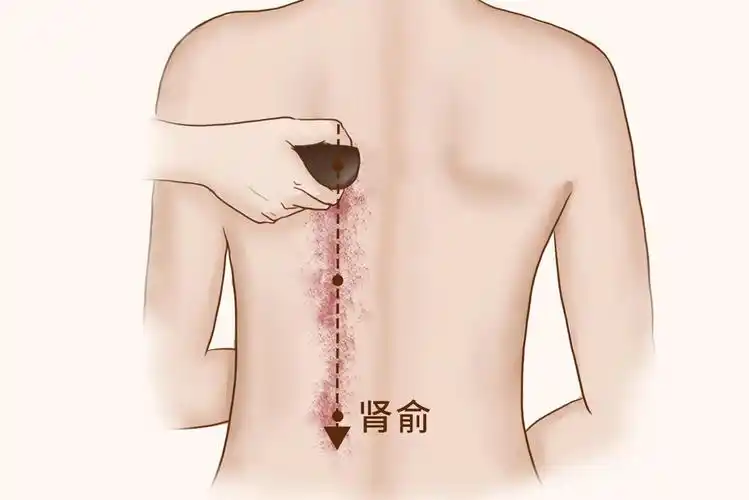 月经不调的患者如果进行刮痧,可以刮肾俞穴,三阴交穴,八髎穴等部位.