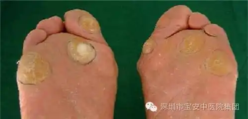 正确认识拇外翻让你足部更健康