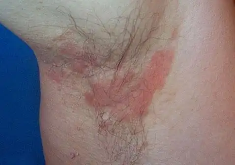 腋窝脂溢性皮炎图片