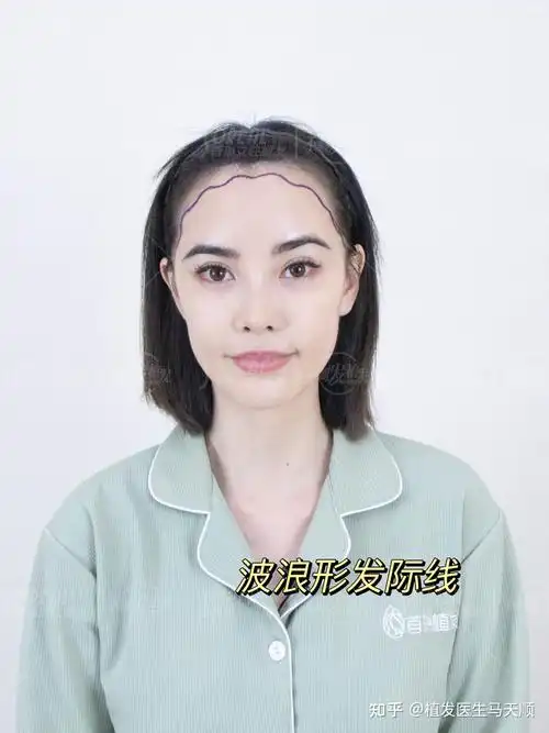 植发医生教你做发际线设计,漂亮又不会出错的发际线有哪些呢?