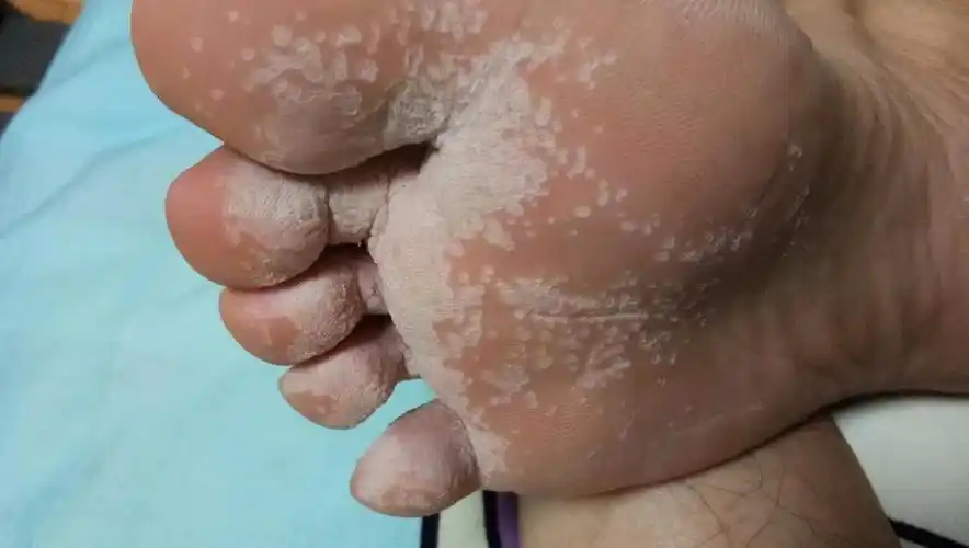 最近脚变得特别臭,洗完后脚底发白