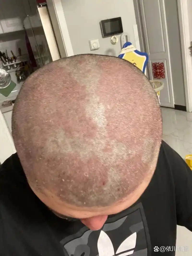 治疗头部牛皮癣小妙招 银屑病中有许多患者会都是头部银屑病,有初起即