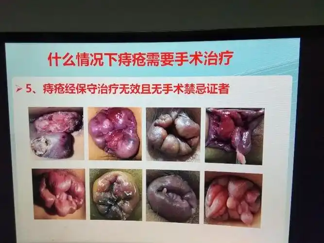 带你认识什么情况下痔疮需要手术治疗