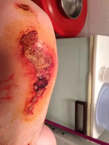 这样得伤口大约几天能好 腿部 膝盖以下