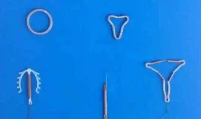 爱母节育环怎么样具有哪些优点