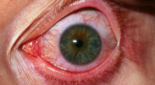 眼睛红血丝针灸