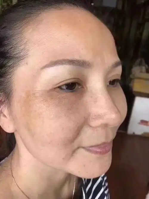 脸上长黄褐斑别急,不妨常吃2种蔬果,建议了解一下