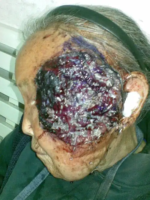 【病例讨论 2009-6】左面部皮肤癌合并蝇蛆感染