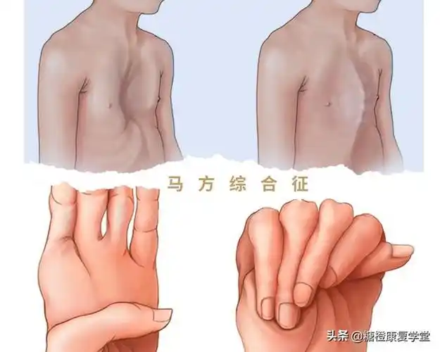 马方综合征引起的脊柱侧弯,有什么不同?