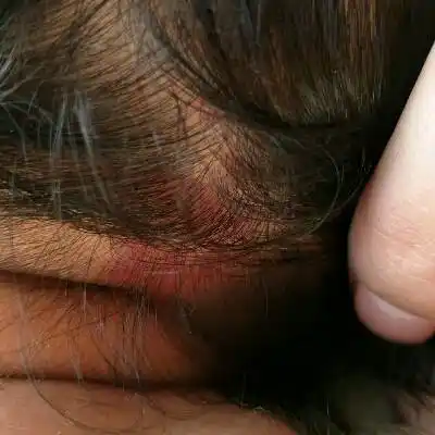 宝宝后脑勺头皮上面红的一块是什麼?