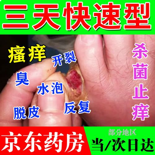 烂脚丫真菌感染止痒严重脚气水泡型脚气盐酸特比萘芬乳膏主图视觉特效