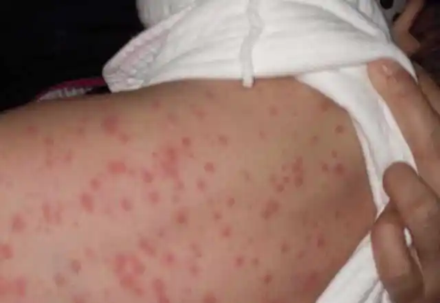 喜悦!宝宝过敏性皮炎"怀孕前期"-第2张图片-维陆网