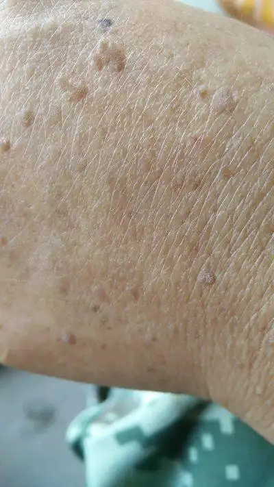 扁平疣怎么治疗能除根?