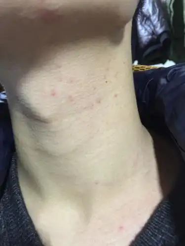 医生你好,我今天洗了澡,发现自己脖子上长了一些红痘痘,不知道是什么?