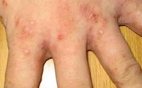 疥疮的生活起居护理