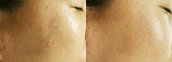 光子嫩肤收缩脸上毛孔前后效果对比