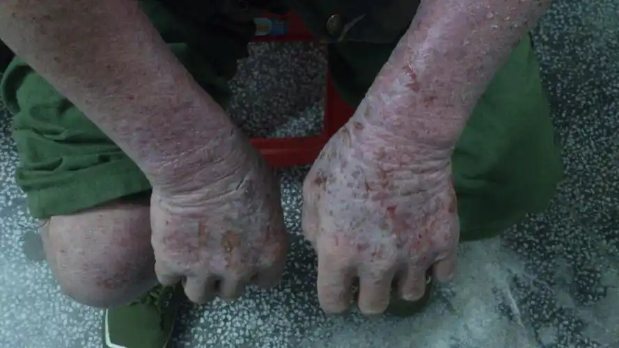 有请皮肤科专家看看这位大爷的皮肤病非常严重