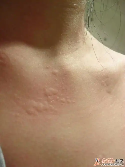 像这样的皮肤过敏,要涂点什么药? 为什么会出现这样的皮肤过敏?