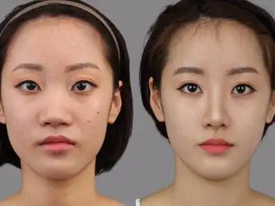 鼻翼缩小需要如何护理?