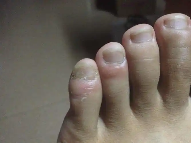 湿疹?怎么治好啊?