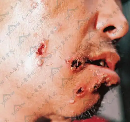 炭疽炭疽杆菌感染病因症状诊疗参考