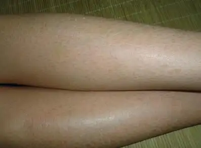 或躯干部皮肤干燥,粗糙,伴有菱形或多角形鳞屑,外观如鱼鳞状或蛇皮状