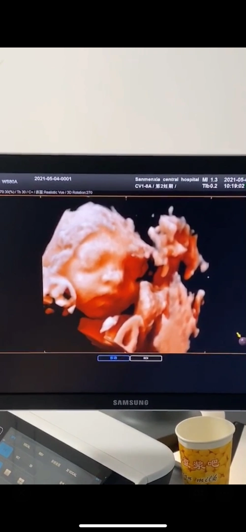 宝贝的四维彩超不知道生下来跟四维一样不一样小脸蛋太_妈妈网孕育
