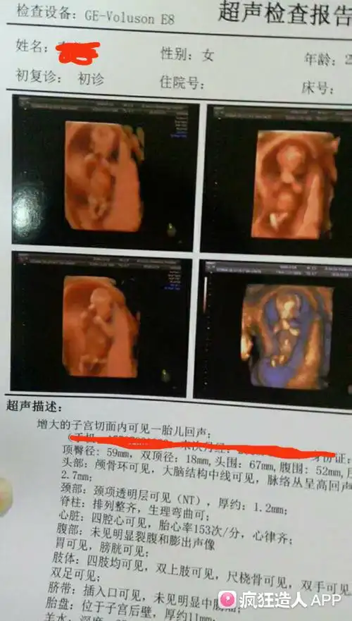 12周nt能看出男女吗