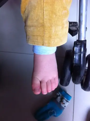 宝宝脚丫子咋回事,见照片.