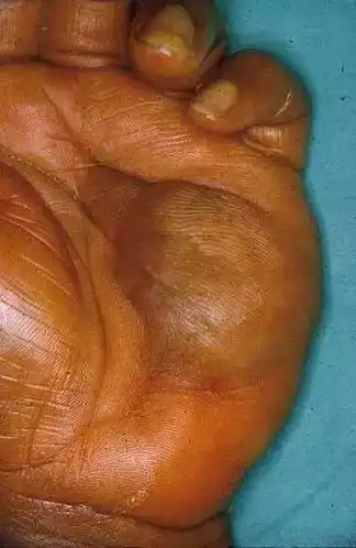 什么是横纹肌肉瘤