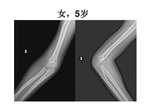 2019--8-26 肘关节x线解剖学